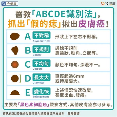 背部很多痣|是痣or皮膚癌？醫「1張圖秒對照」 長這2部位最危險